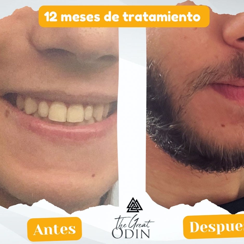 Antes y después del tratamiento de crecimiento The Great Odin RITUAL DE CRECIMIENTO VIKINGO en el cabello.