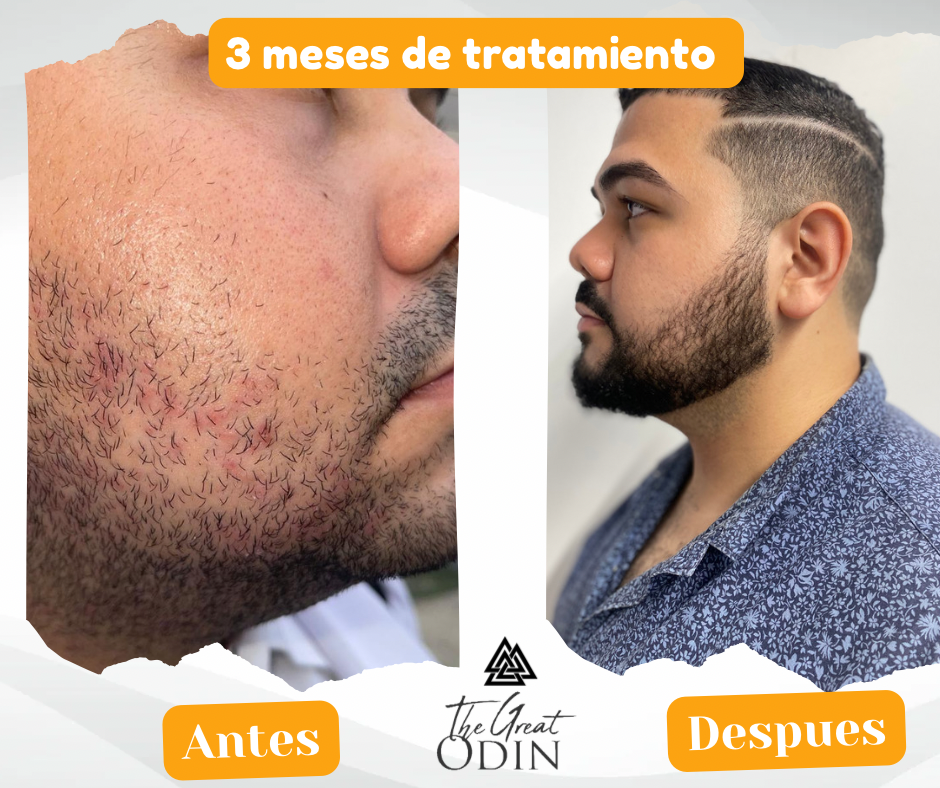 Kit completo para barba The Great Odin, mostrando el antes y después del cuidado facial de Jonas.